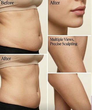 CoolSculpting treatment results